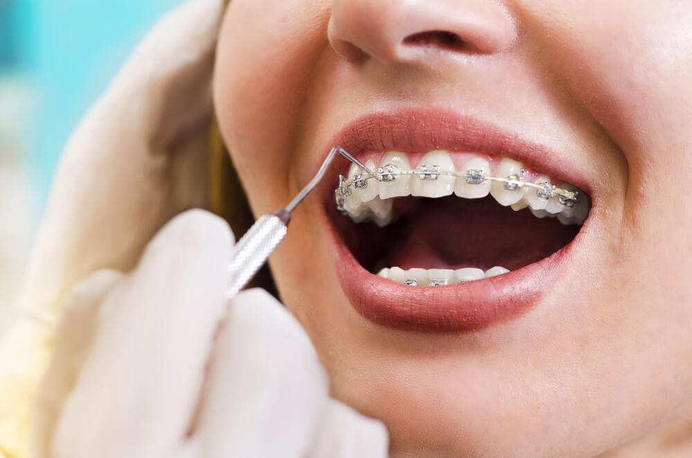 Tratament ortodontic la Dentsthetic